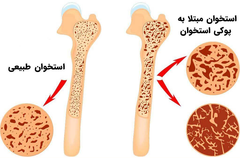 پوکی استخوان؛بیماری خاموش،اما قابل پیشگیری