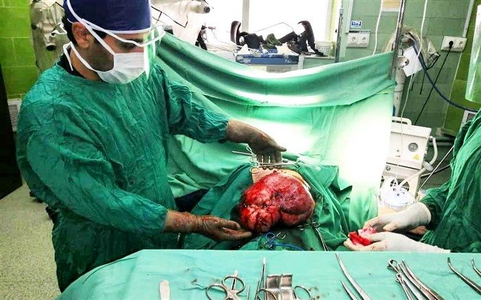 انجام عمل موفقیت آمیز جراحی توده حجیم شکمی در مرکز آموزشی، پژوهشی و درمانی ٢٢بهمن