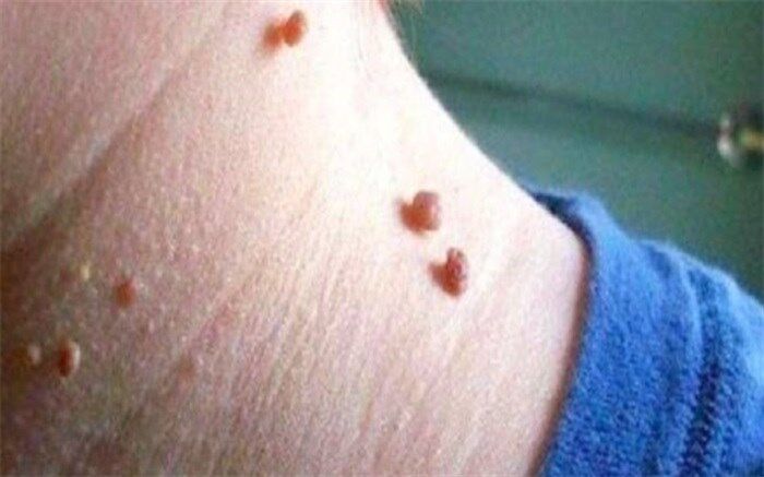 چگونه از شر زگیل‌ها خلاص شویم؟