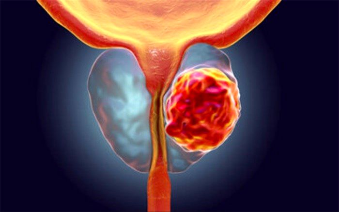 میزان شیوع و عوامل موثر بر بی‌اختیاری ادرار پس از جراحی سرطان پروستات