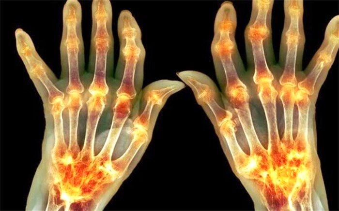 یک درصد از مبتلایان به کرونا دچار التهاب مفصلی و ورم مفاصل می‌شوند
