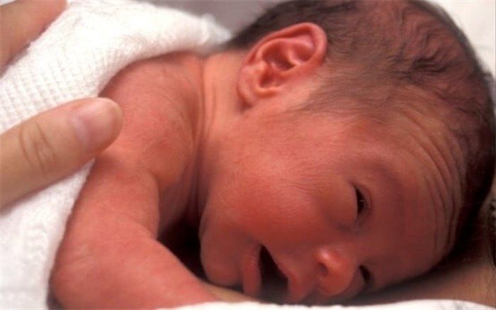 عارضه گلوکوم در کمین نوزادانی که تحت جراحی آب مروارید قرار می گیرند