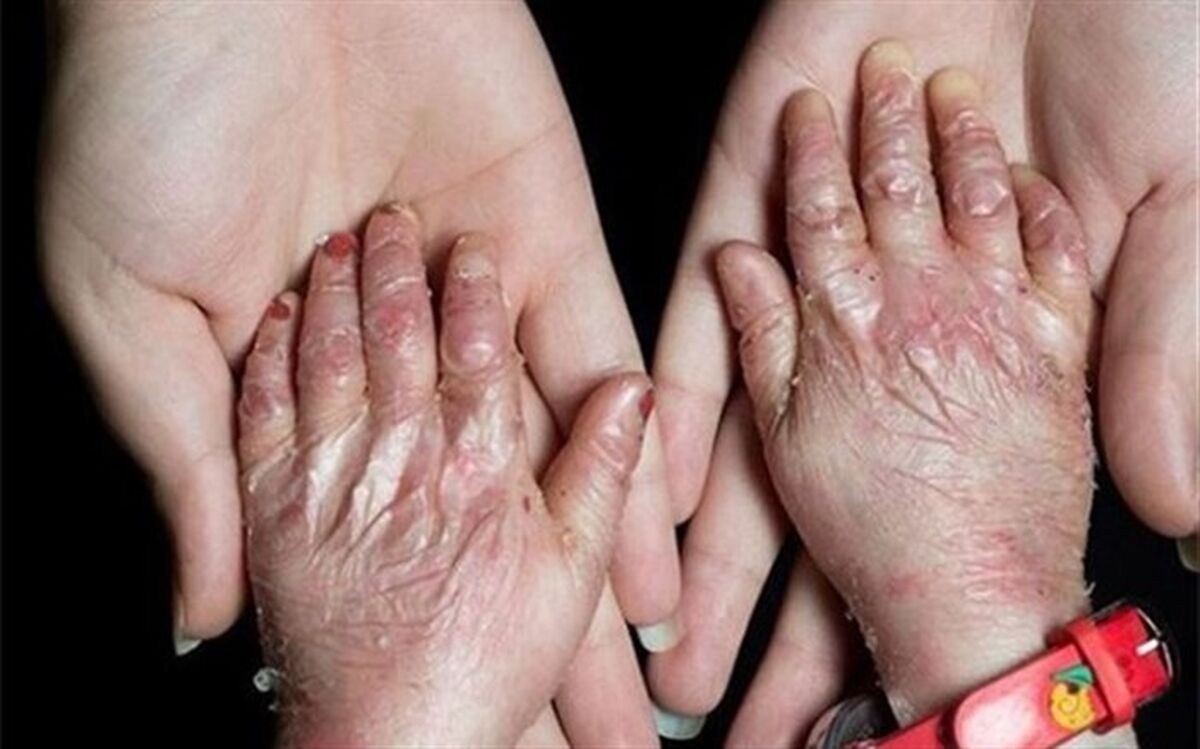 شناسایی بیش از ۸هزار نوع بیماری نادر در دنیا
