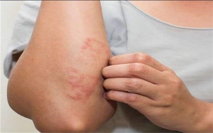 ۹ ماده غذایی  که باعث خارش می‌شود