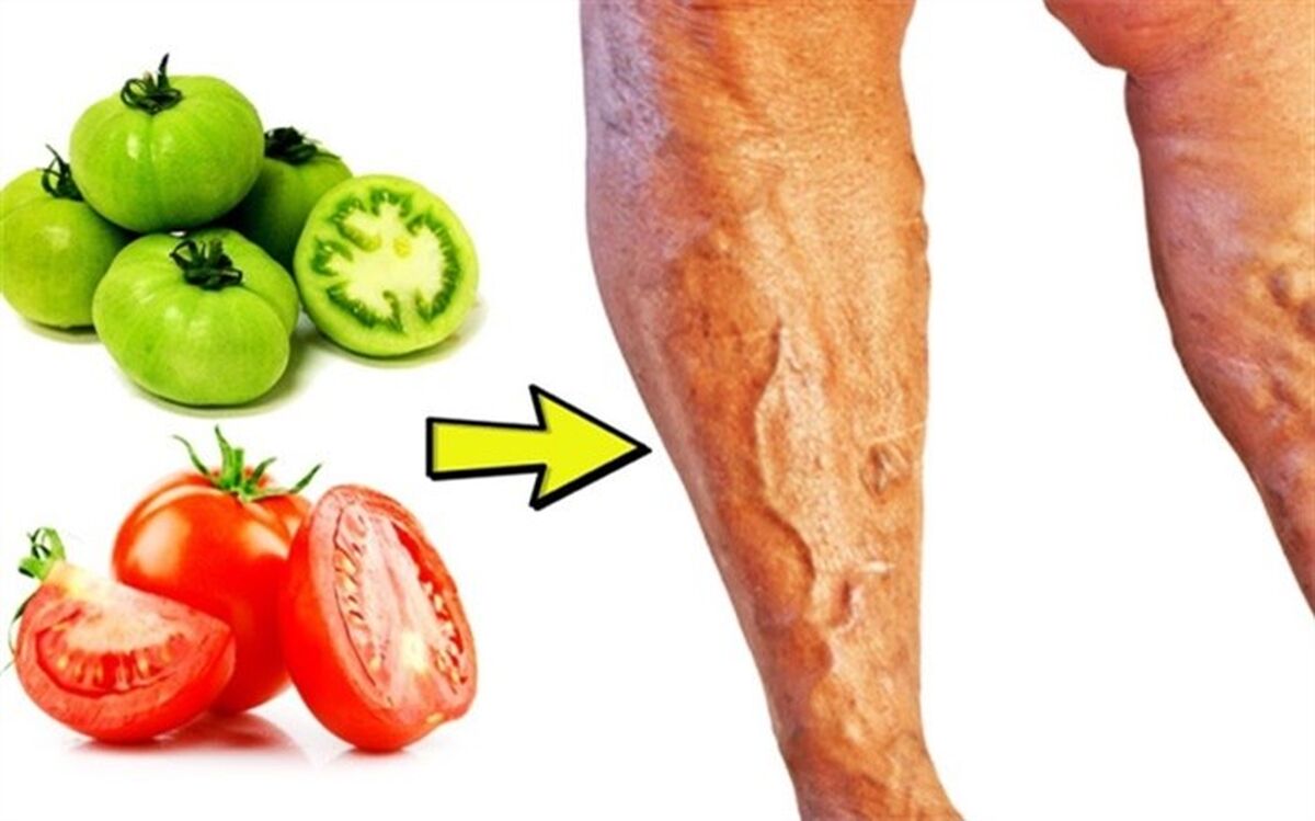 برطرف کردن واریس با  این میوه