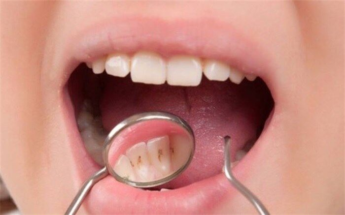 خوراکی‌هایی که به دندان‌ها آسیب می‌زند