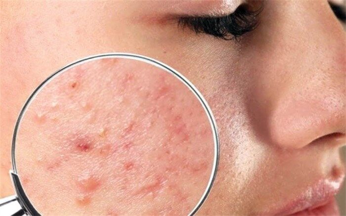محل جوش‌ها روی صورت چه اطلاعاتی به ما می‌دهد؟