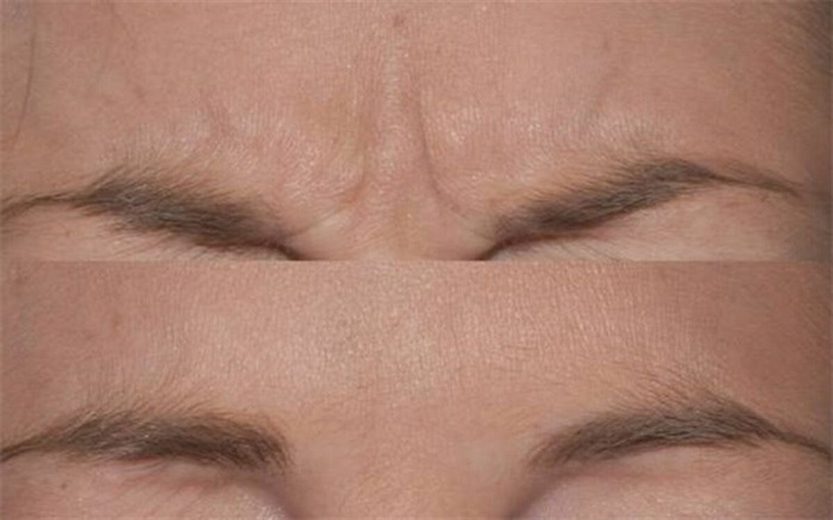 راهکارهای طبیعی برای از بین بردن خط اخم