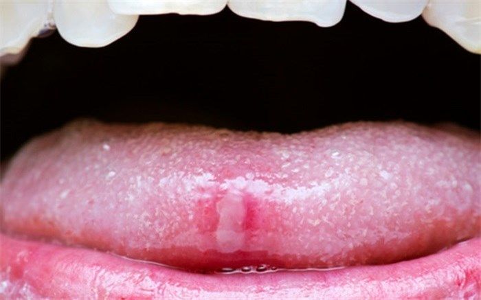 دلایلی که باعث بی حسی زبان می‌شوند