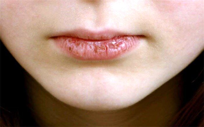 راه‌های بهبود خشکی دهان