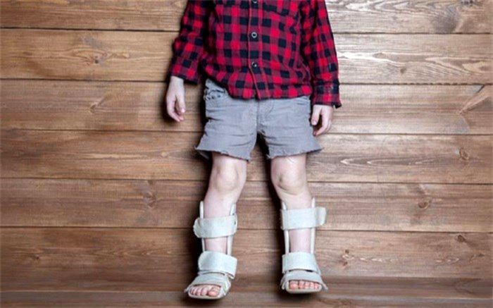 عامل اصلی بروز نرمی استخوان مشخص شد