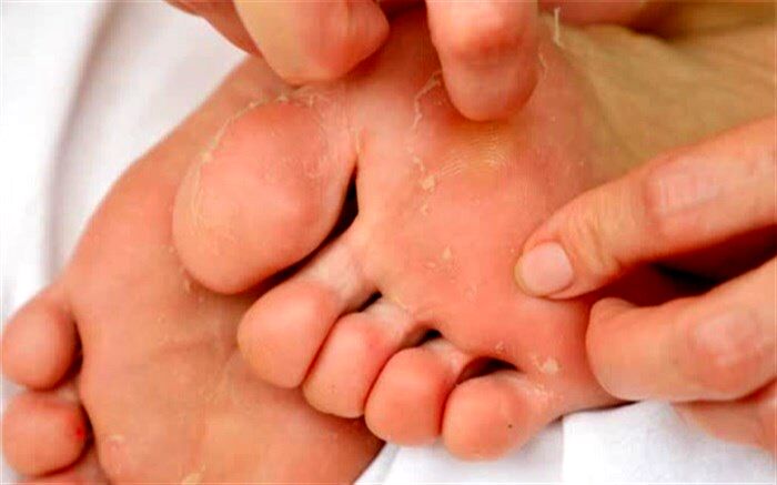چرا کف پا پوسته پوسته می‌شود
