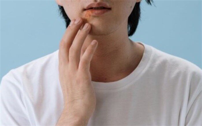 چند توصیه بهداشتی درباره تبخال