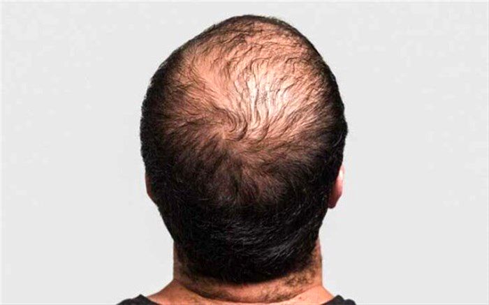 با این روش از ریزش مو جلوگیری کنید