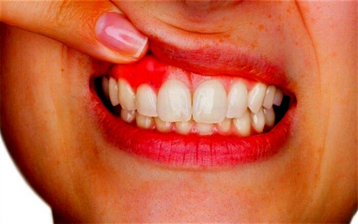 "خونریزی لثه" را جدی بگیرید
