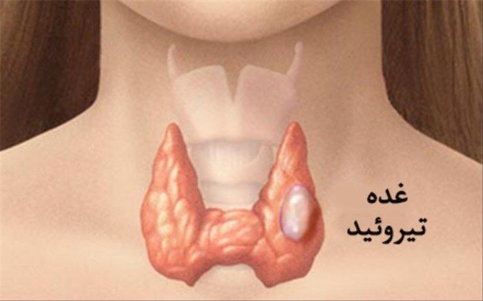 علائم سرطان تیروئید