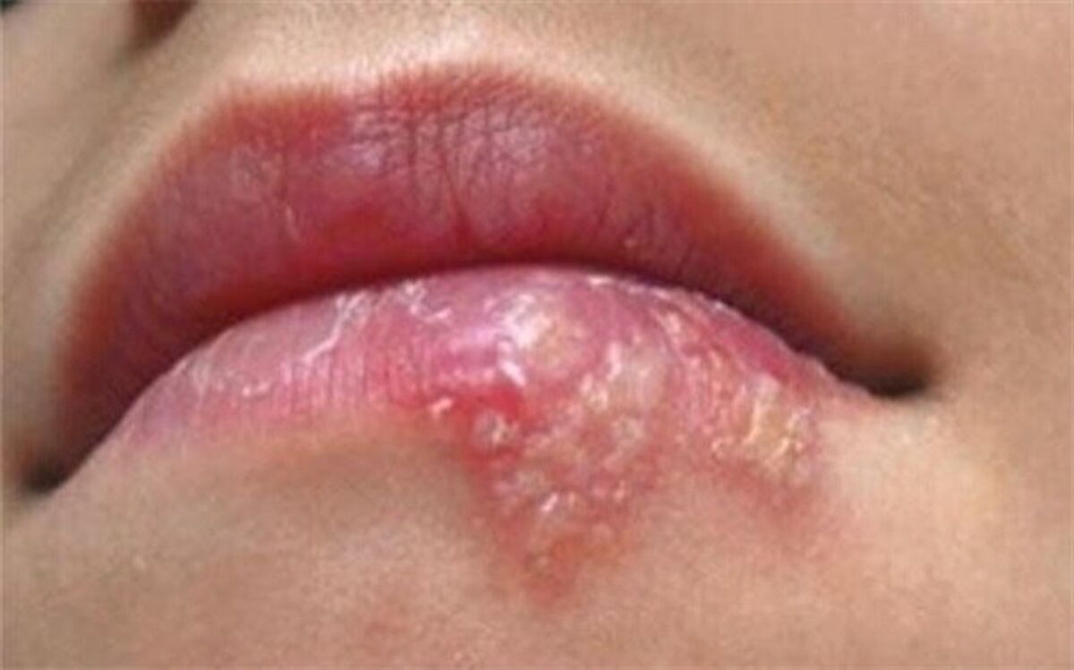 چگونه با کمک طب ایرانی در خونه تبخال رو درمان کنیم؟/فیلم