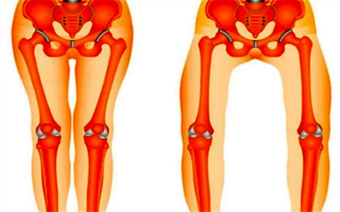 پای پرانتزی باعث آرتروز می‌شود؟
