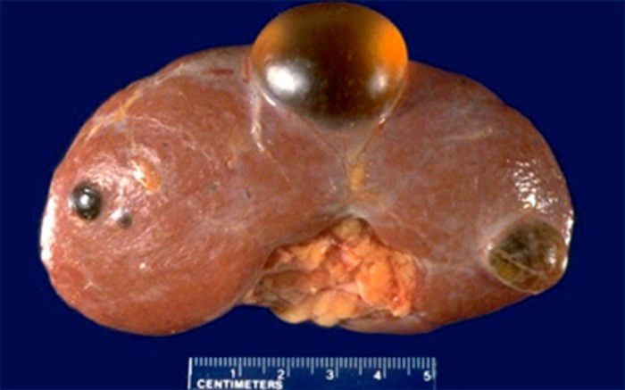 کیست کلیه درمان دارد؟