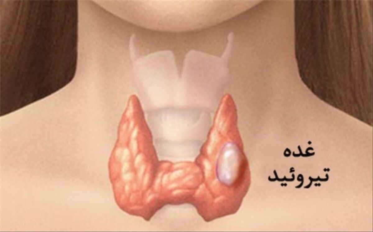 هر آنچه باید درباره گره تیروئید بدانید