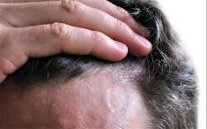 قیمت کاشت مو در بهترین کلینیک پوست و موی تهران