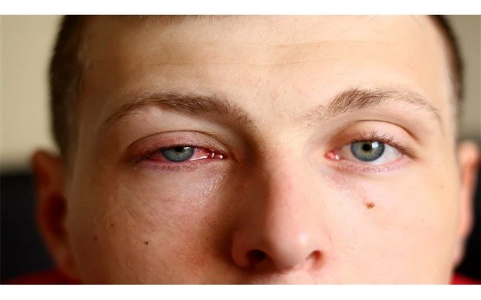 بین قرمزی چشم و کرونا رابطه‌ای وجود دارد؟