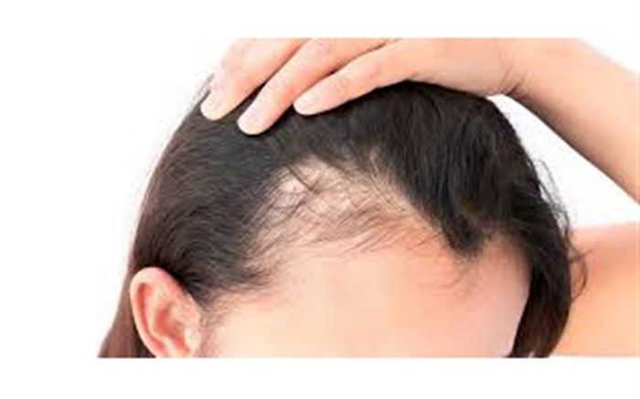 این ماده غذایی باعث تشدید ریزش مو می‌شود