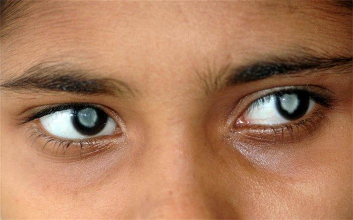 عواملی که باعث آب مروارید می‌شود