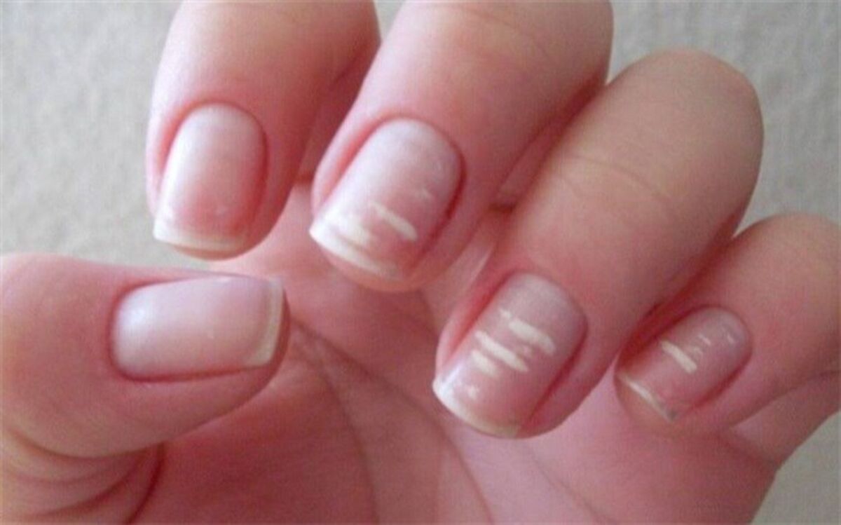 10 نشانه‌ کمبود کلسیم در بدن