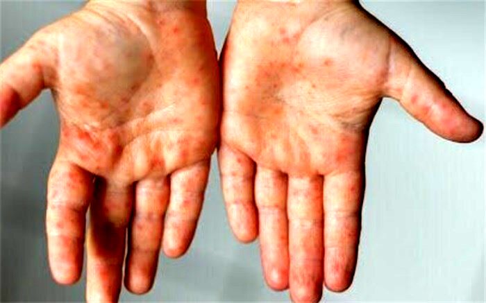 واکسیناسیون ۲۳۰ هزار اتباع غیرایرانی علیه سرخک تاکنون