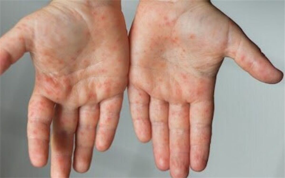 واکسیناسیون ۲۳۰ هزار اتباع غیرایرانی علیه سرخک تاکنون