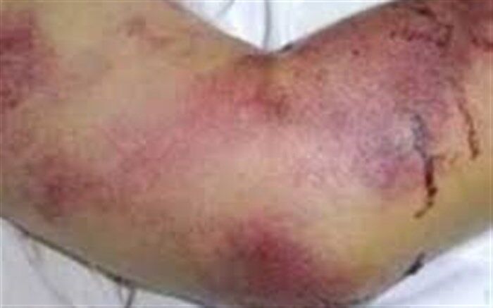 شناسایی ۳ بیمار مبتلا به تب کریمه کنگو در کشور