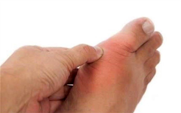 اگر نقرس دارید این خوراکی‌ها را مصرف کنید