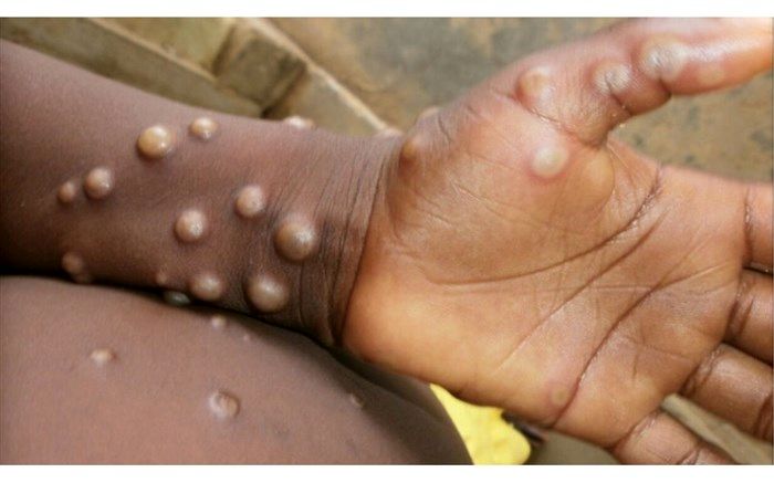 طغیان «آبله میمونی» در راه است؟