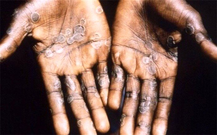 صفر تا صد بیماری «آبله میمون»