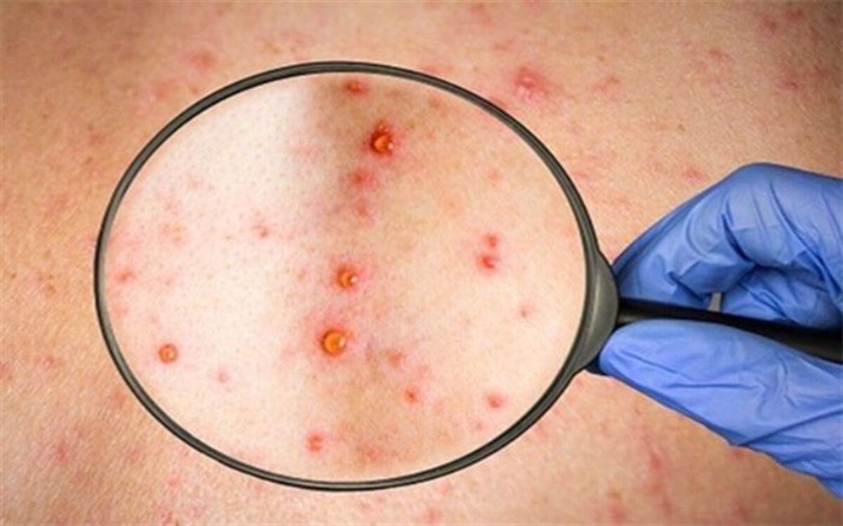 احتمال افزایش موارد ابتلا به آبله میمون در تابستان