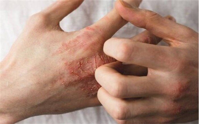 6 راهکار برای کاهش خشکی پوست در زمستان