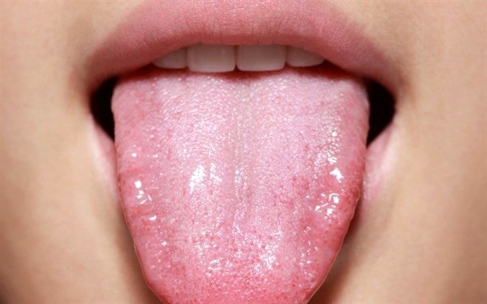 برفک دهان نشانه چیست؟