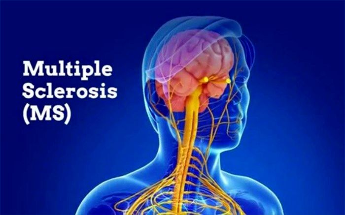 این علامت‌ها باعث تشدید ام‌اس می‌شود