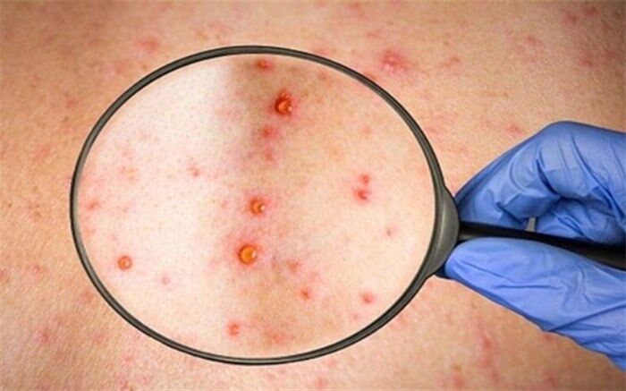 چه کسانی در معرض خطر ابتلا به آبله میمون هستند؟