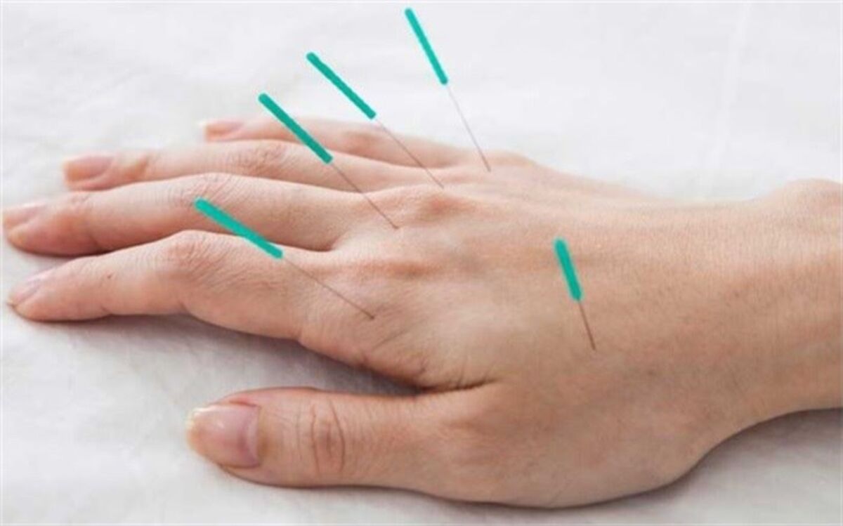 طب سوزنی چه عوارضی دارد؟