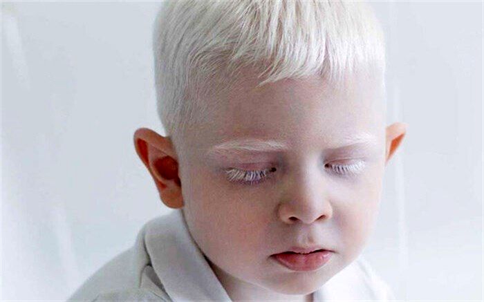 «آلبینیسم» چیست و چه علائمی دارد؟
