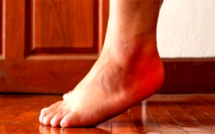 ورم پا به چه دلایلی ایجاد می‌شود؟