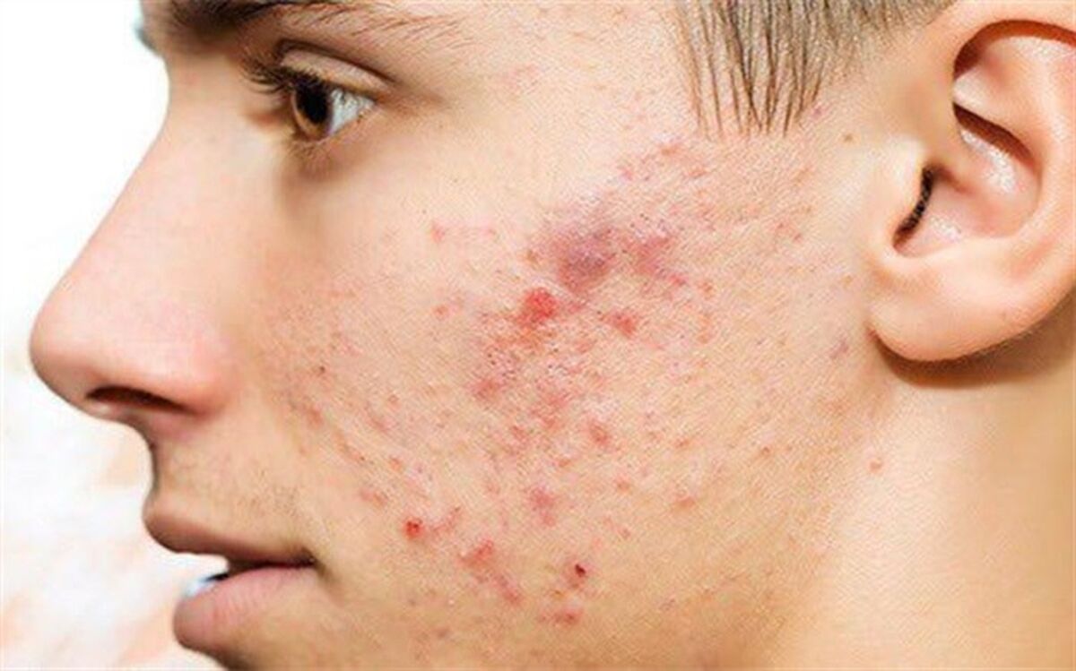 جوش صورت نشانه بیماری است؟