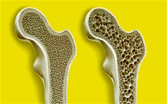 با علائم اولیه کمبود کلسیم در بدن آشنا شوید