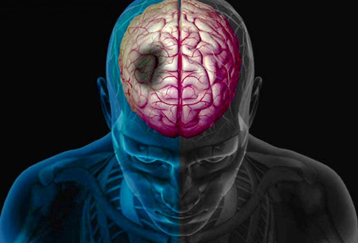 هر ۴۰ ثانیه، یک سکته مغزی در آمریکا رخ می‌دهد