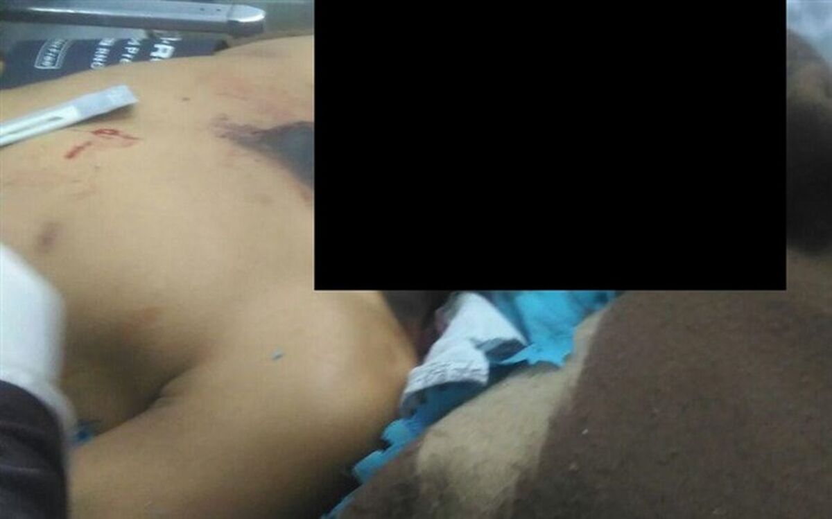 انفجار بمب دستی نوجوان  ۱۳ ساله را به شدت مجروح کرد