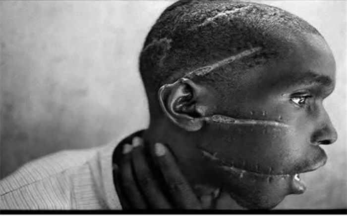 خراش های نفرت روی صورت جوان رواندایی