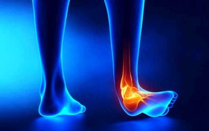 نکاتی که در مورد پیچ‌خوردگی مچ پا باید بدانید