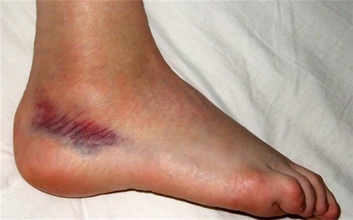 بیماری‌هایی که موجب کبودی پوست می‌شوند